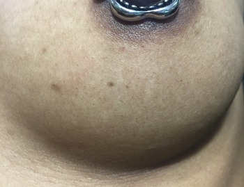 Bear Trap Nipple Piercing Installed at Iron Palm Tattoos in Atlanta. Call 404-974-7828 or stop by for a free consultation with an Iron Palm Body Artist. Walk-Ins are welcome!